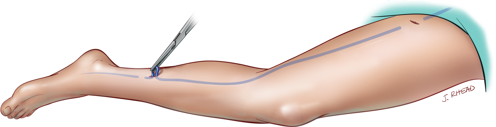 Treatment-vein Stripping - Leather Clipart (1614x465), Png Download