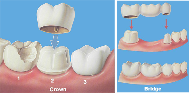 Dental Crowns And Bridges Clipart (949x333), Png Download