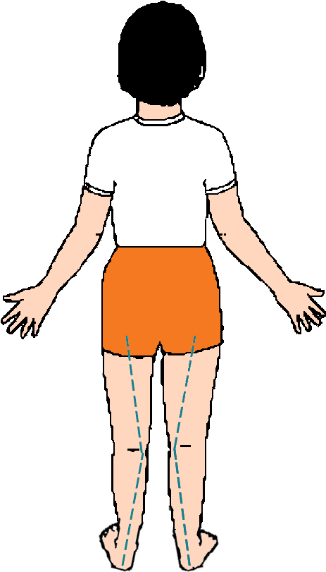 "over Pronation" Means That, As Your Child Walks They - Illustration Clipart (476x831), Png Download