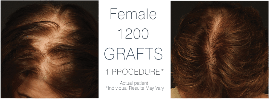 Her Journey - Women Diffuse Thinning Clipart (1024x372), Png Download