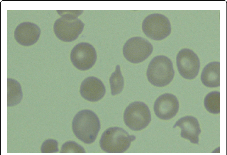 Peripheral Blood Smear With Schitocytosis - Circle Clipart (769x524), Png Download