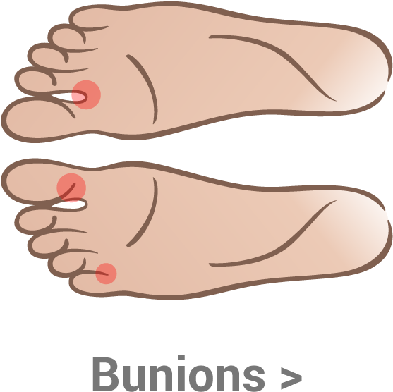 Heel-pain - Bunion On Inside Of Big Toe Clipart (700x700), Png Download