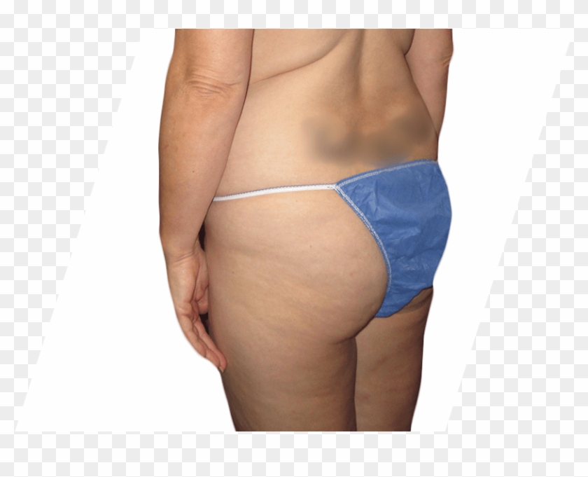 Before Brazilian Butt Lift - Thong Clipart