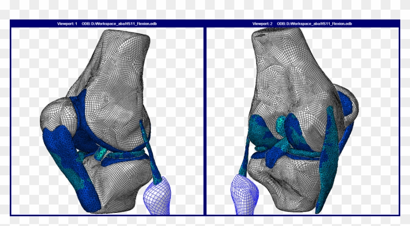Human Knee Joint Fe Model - Finite Element Model Of The Knee Clipart #1023198