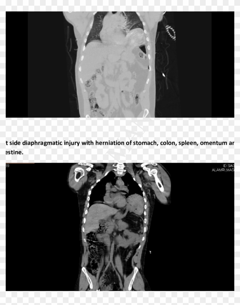 Herniated Organ Seen With The Edge Of The Tear - Radiology Clipart #1031330