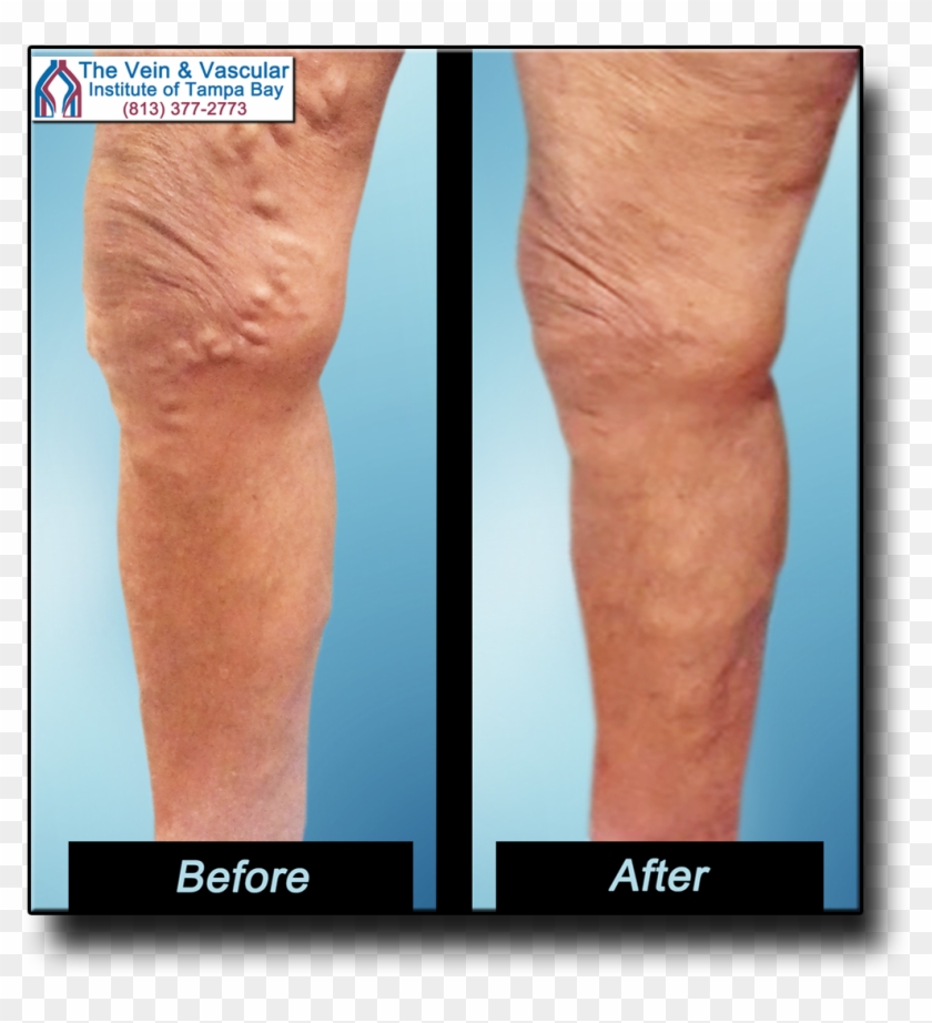 Get Rid Varicose Veins Naturally - Varicose Veins Surgery Clipart #1086261