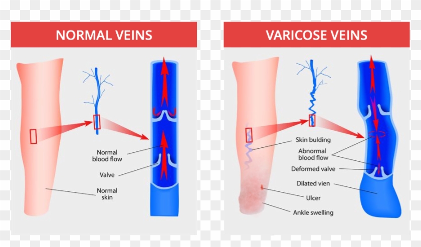 Open Skin Ulcers - Normal Vein Vs Varicose Vein Clipart #1086423