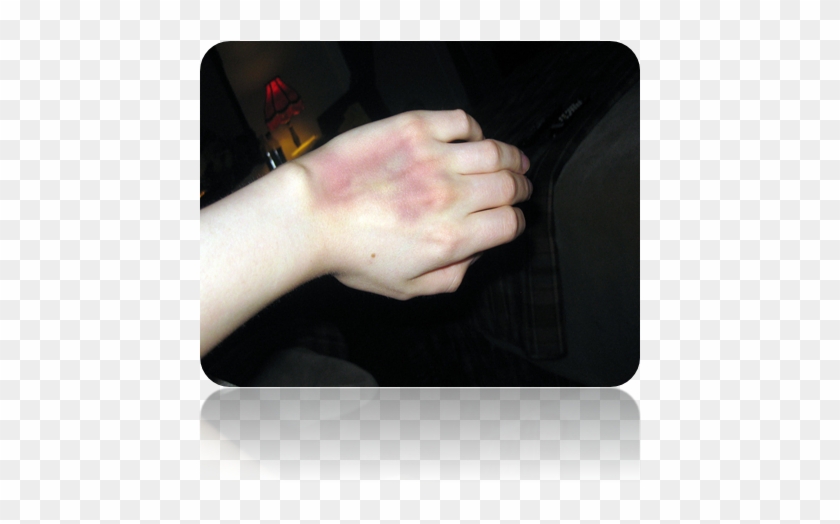 Ivhand-bruise - Netbook Clipart