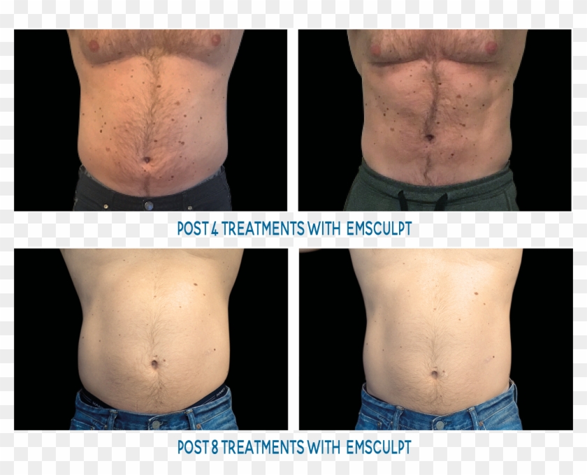 Male Abs Before And After - Emsculpt Before And After Men Clipart #1164934