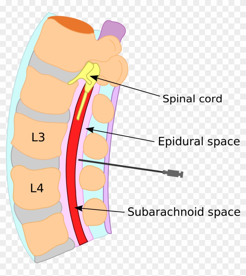 Epidural Blood Patch - Spinal Fluid Clipart