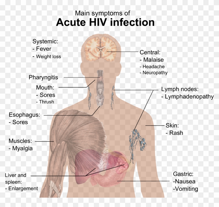 Symptoms Of Acute Hiv Infection - Hiv Symptoms Clipart #1217064