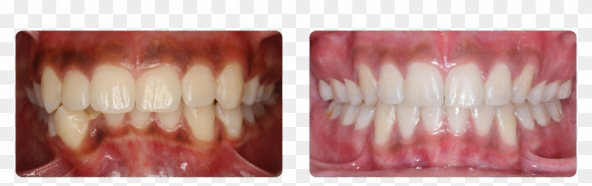 Deep Bite And Severe Lower Crowding That Were Corrected - Vampire Clipart #1254662
