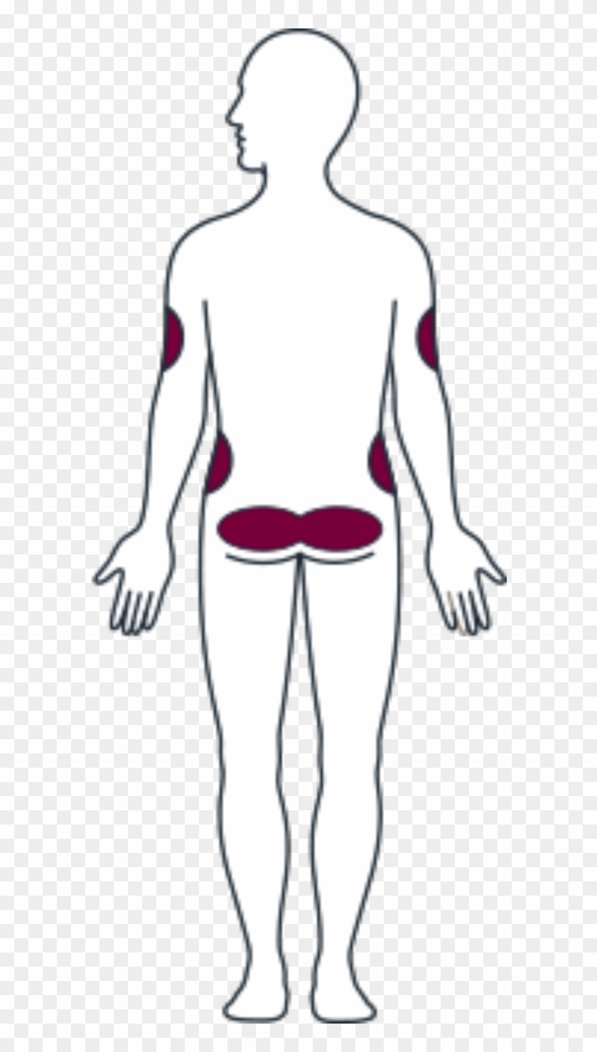 Back Side Appropriate Injection Sites - Illustration Clipart