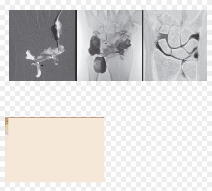 Triangular Fibrocartilage Tear Syndrome - Visual Arts Clipart