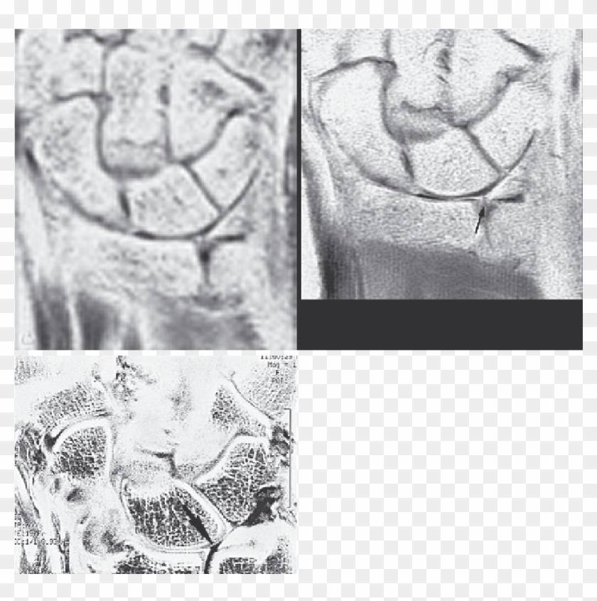 Triangular Fibrocartilage Tear Syndrome - Sketch Clipart