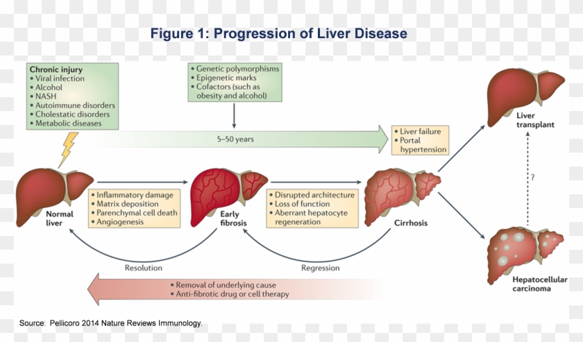 A Number Of Companies Are Currently Developing Treatments - Overview Liver Disease Clipart #1298669