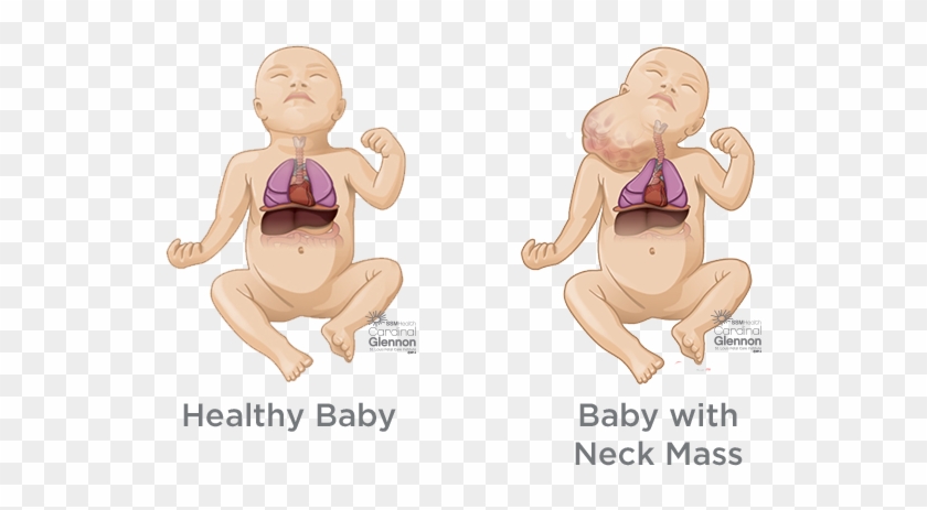 Fetal Neck Masses - Fetal Teratoma Neck Clipart #1305689
