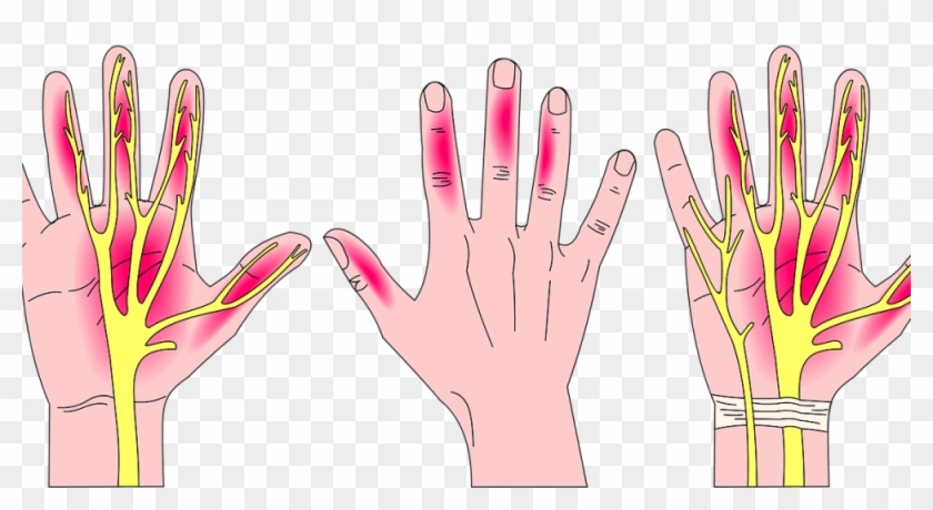 Carpal Tunnel Syndrome Painting Clipart #1315433