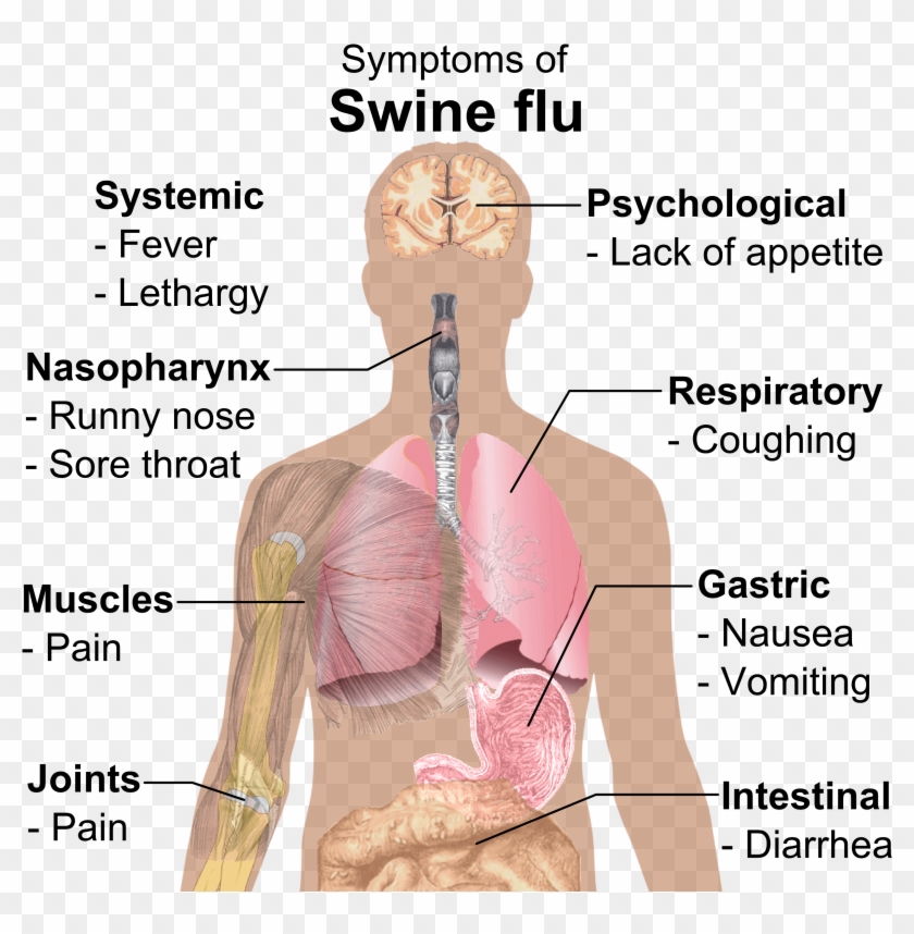 Symptoms Of Swine Flu - Dic Hemolytic Transfusion Reaction Clipart #1316967