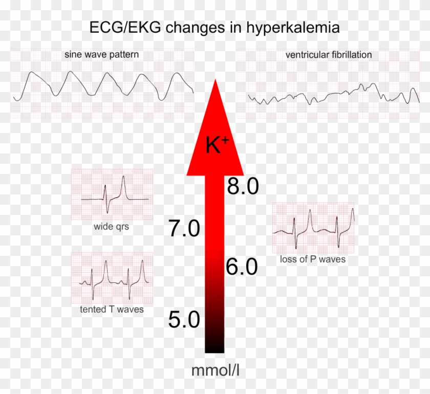 Hyperkalemia6 - Hyperkalemia Ecg Changes Clipart #1350127