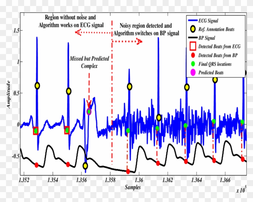 In Noisy Zones Of Ecg, Bp Signal Will Be Used For Heartbeat - Heartbeat Detection Algorithm Clipart #142001