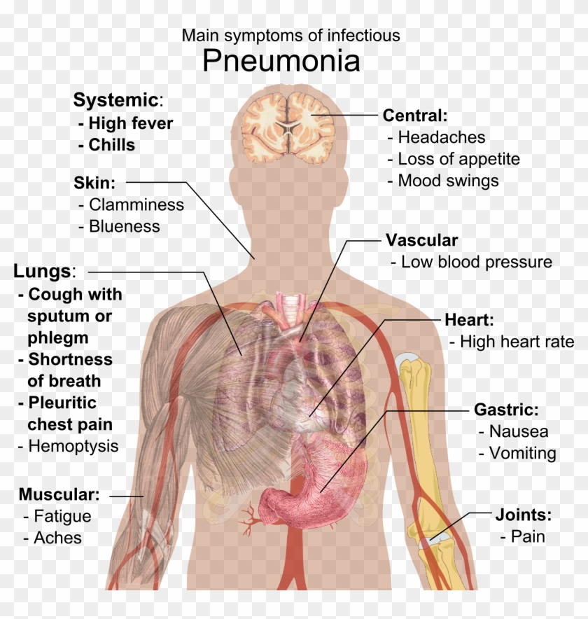 Main Symptoms Of Infectious Pneumonia - Pneumonia Symptoms Clipart