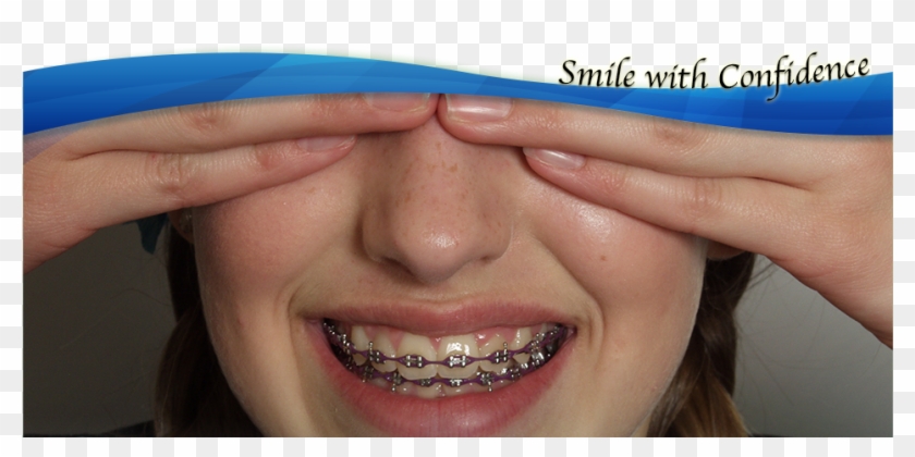Life With Braces - Close-up Clipart