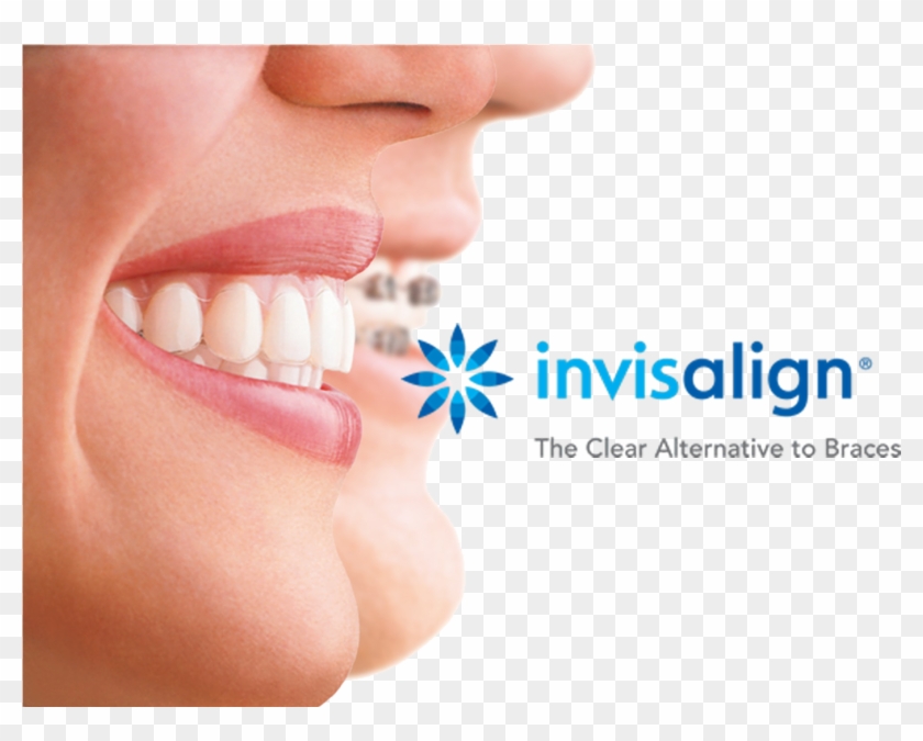 //cdn2 - Hubspot - - Clear Aligners Clipart #1415373