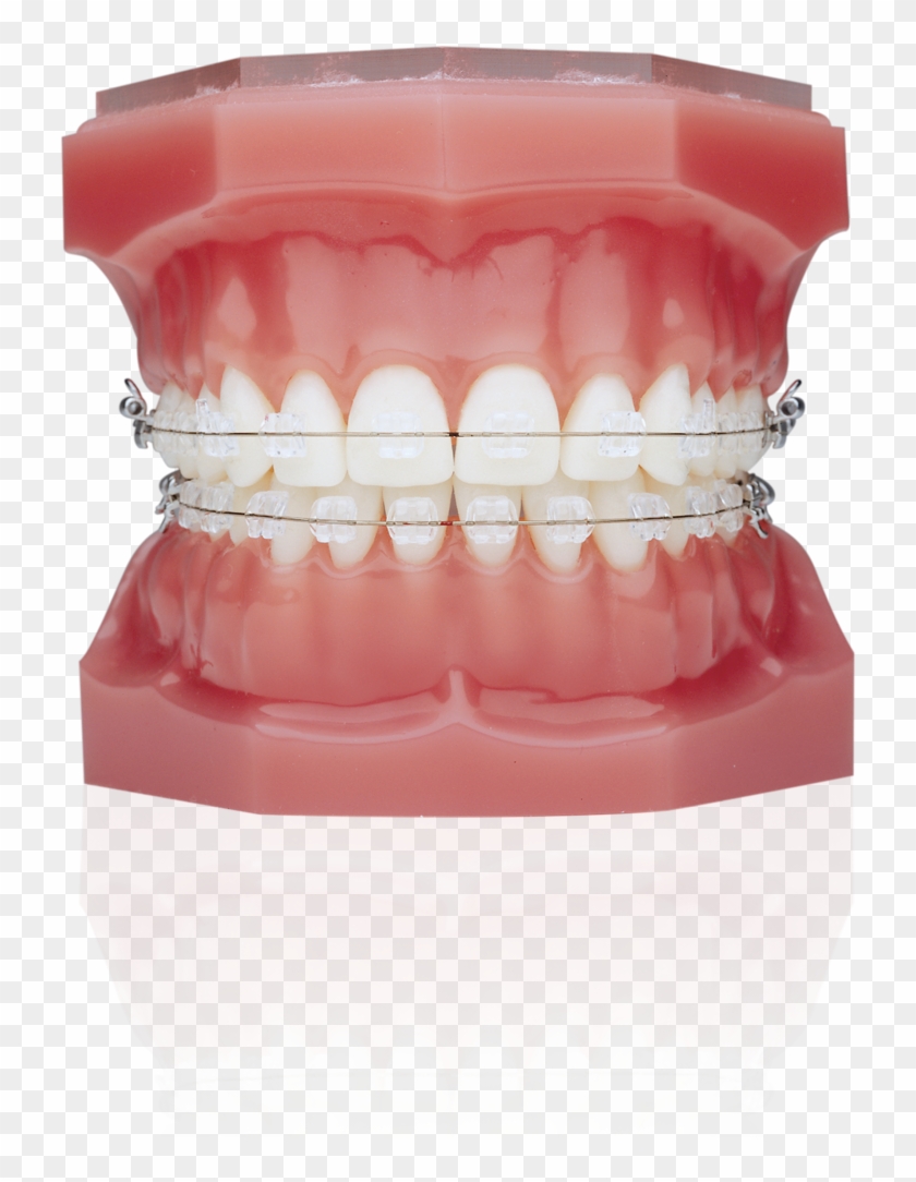 Ice Clear Braces Clipart #1415433