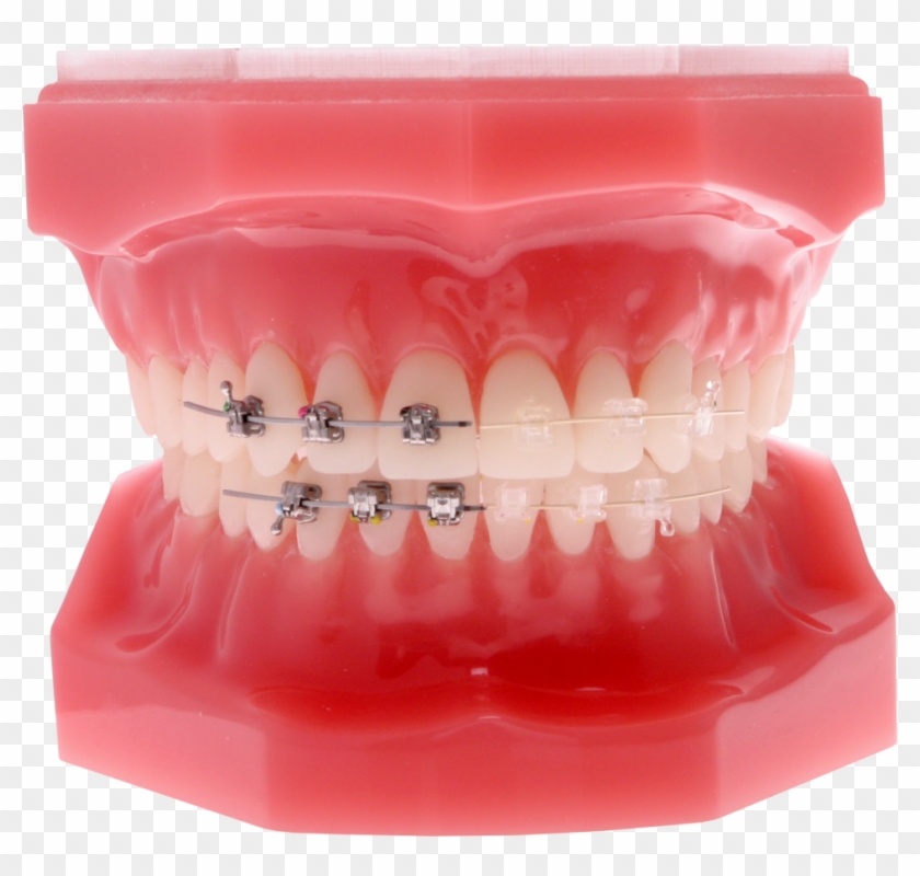Self-ligating Braces - - Self Ligating Clear Braces Clipart