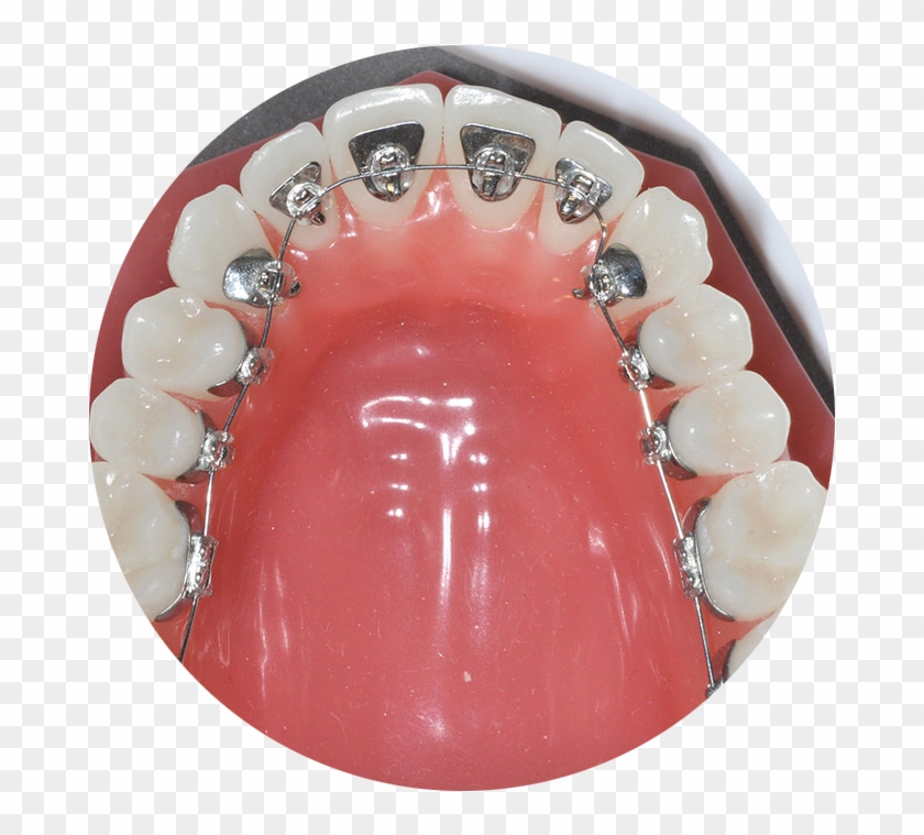 Lingual Braces - Orthodontics Clipart