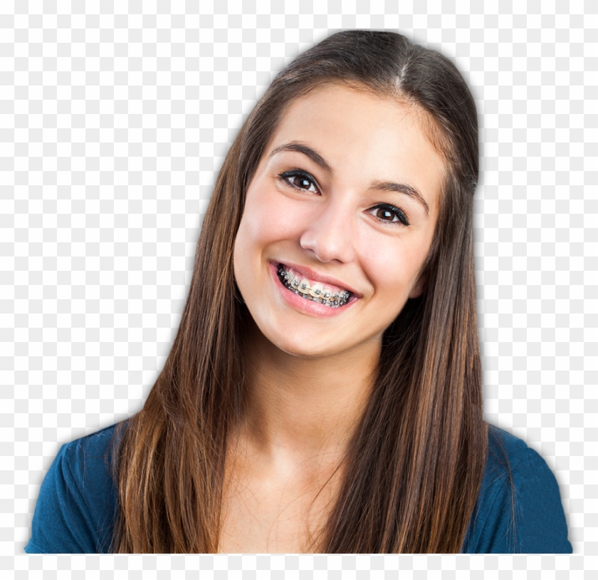 Sonrisa Con Brackets Png - Pessoas Sorrindo Com Aparelho Clipart