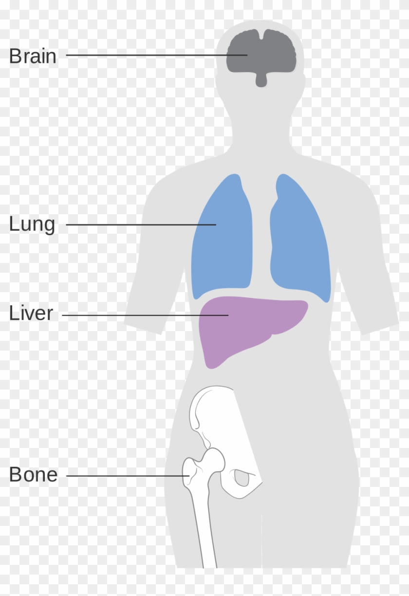 Breast Cancer Metastasis Clipart #1435758