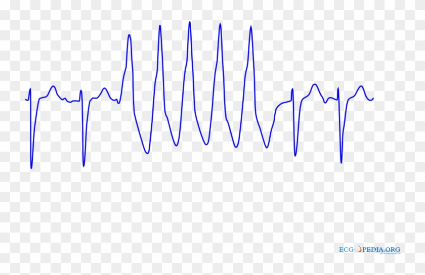 Ventricular Tachycardia 2 - Nsvt Ecg Clipart