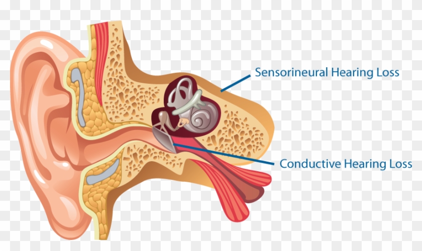 Loss Png - Types Of Hearing Loss Clipart