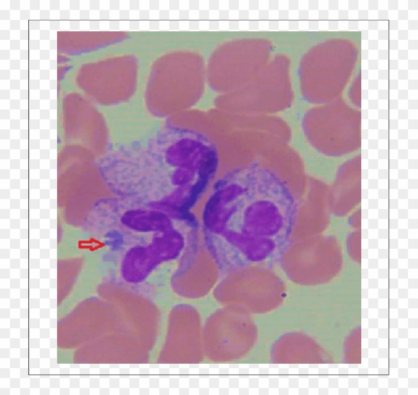 Peripheral Smear From Hospital Day 2 Showing Rare Morula - Morula Inclusions Clipart