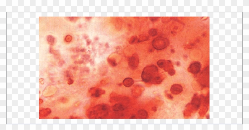 A Synovial Fluid Wet Smear Stained With Alizarin Red - Hydroxyapatite Crystals Alizarin Red Clipart #160588