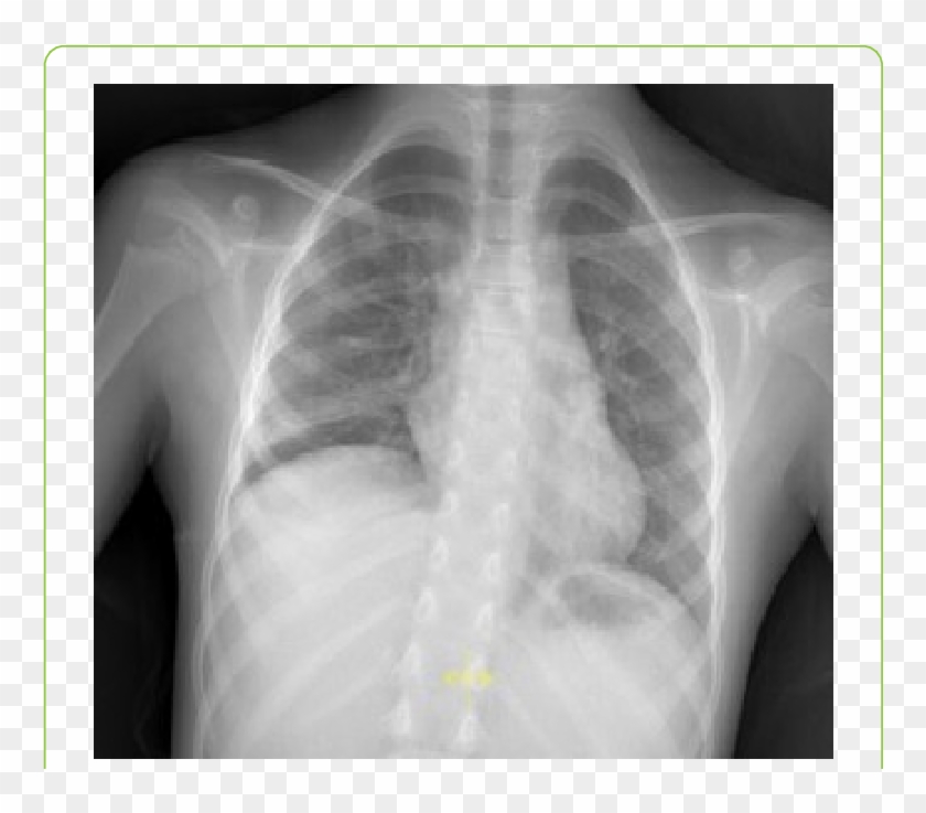 Elevation Of The Right Hemidiaphragm In Relation To - Right Hemidiaphragm Elevation Clipart