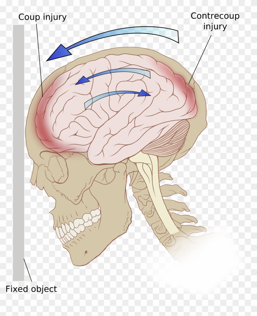 An Introduction To A Concussion A Bruise To The Brain - Charles Bonnet Syndrome Facts Clipart #1653842