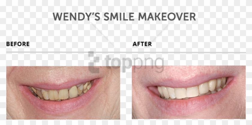 Free Png Download Teeth Makeover Png Images Background - Teeth Makeover Clipart #1659841