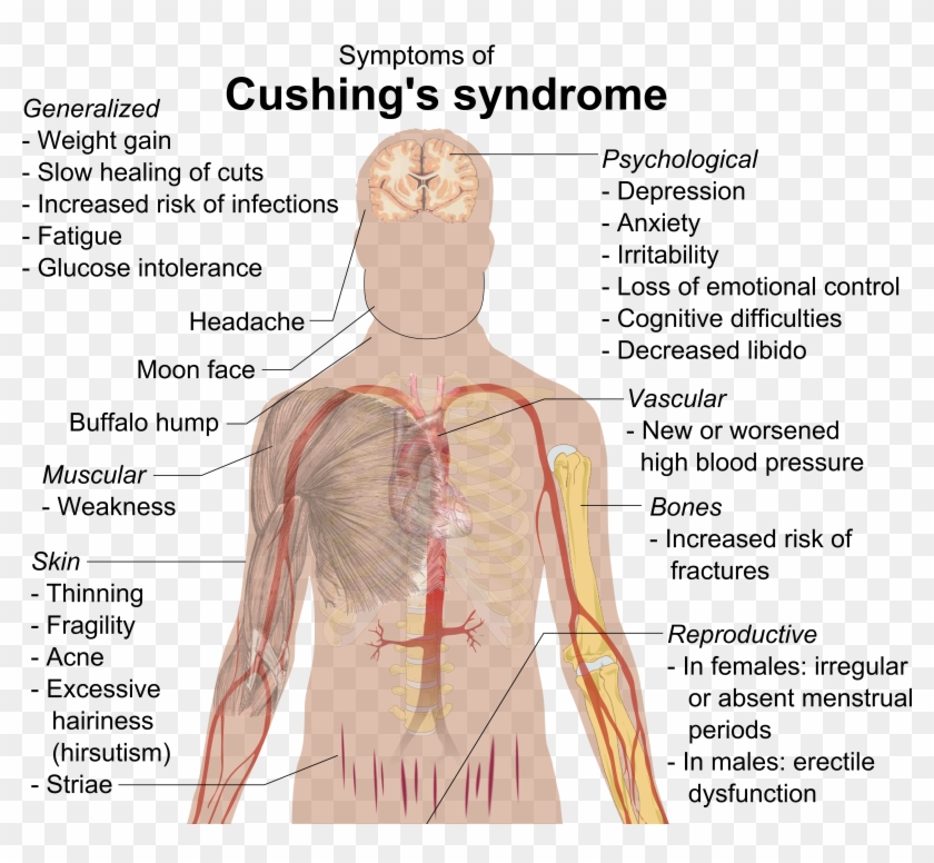 Cushing's Syndrome - Cushing's Syndrome Addison's Disease Clipart #1703923