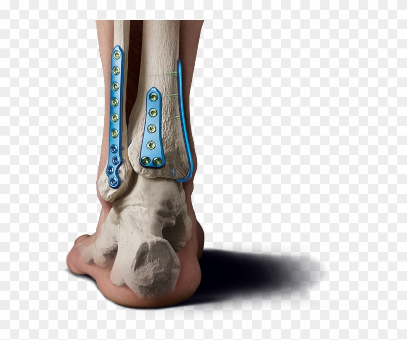 Medline Ankle Fracture Set Clipart #1724656