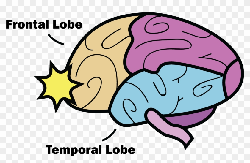 The Anatomy Of A Concussion - Concussion Frontal And Temporal Lobe Clipart #1736158