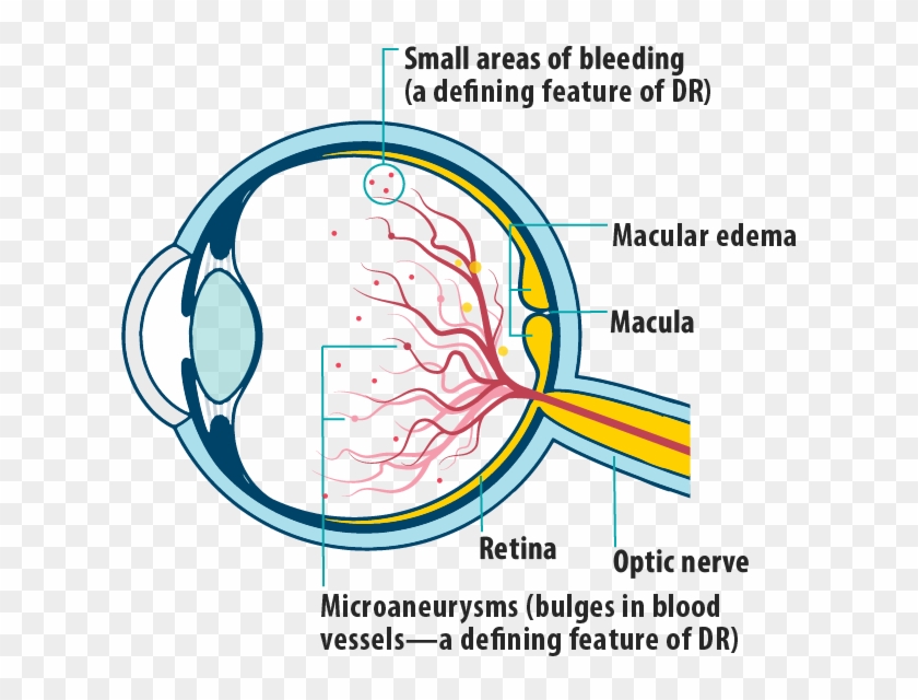 Picture Of Effects Of Dme/dr In Dme On The Eye, Showing - Central Retina Vein Occlusion Vs Clipart #1849243