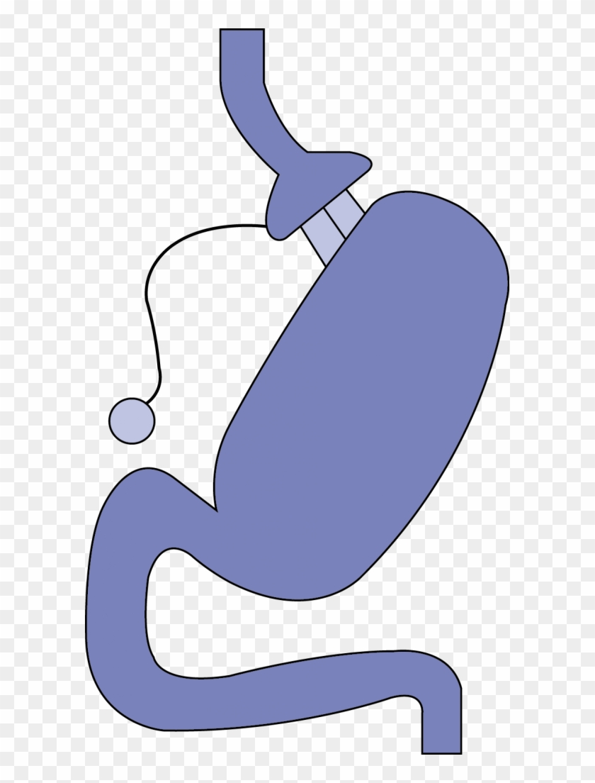Adjustable Gastric Band Or Lap Band Clipart