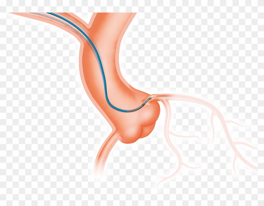 Heartrail Ii Is Developed To Maximize Your Back-up - Catheter Tig Clipart