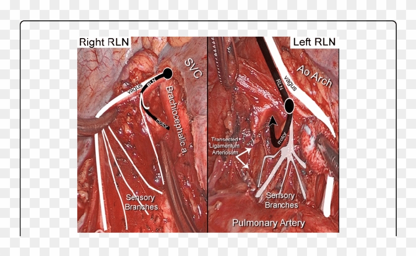 Sensory Twigs Given By Vagus And Rln At Right Point - Visual Arts Clipart #1922788