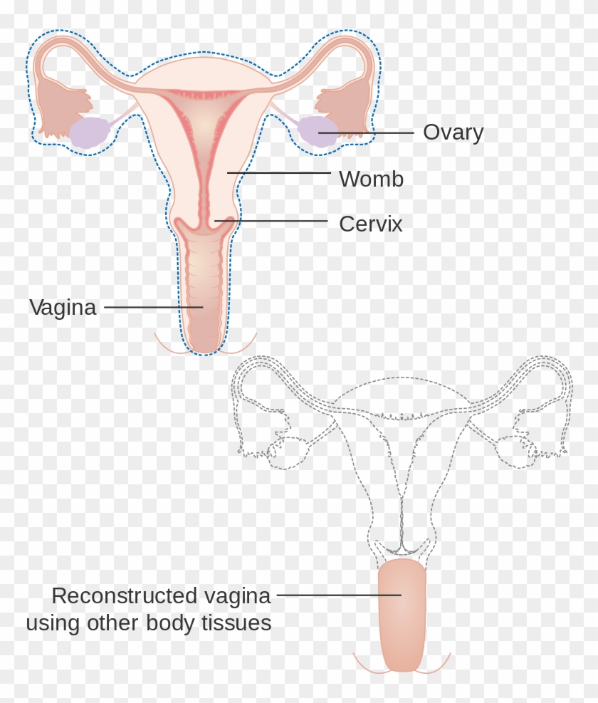 Diagram Showing A Radical Hysterectomy With A Reconstructed - Reconstructed Vagina Clipart #1935138
