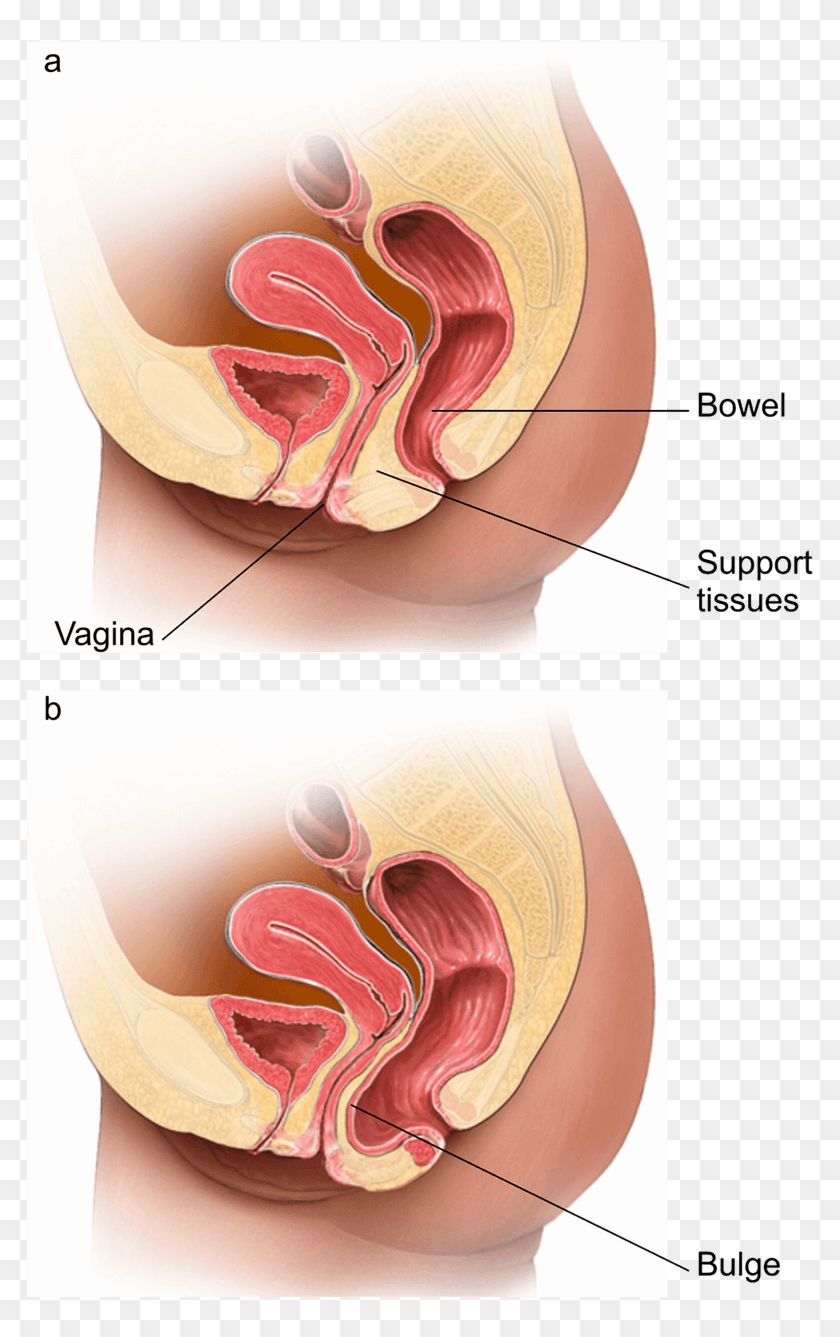Illustration Showing A Normal Vagina And One With A - Posterior Prolapse Clipart #1935403