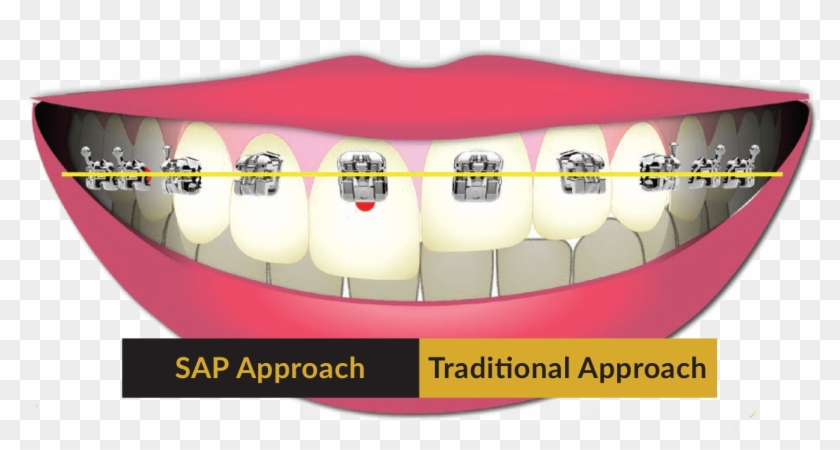 Saoly Benson Utilizes Smile Arc Protection When Treatment - Tongue Clipart